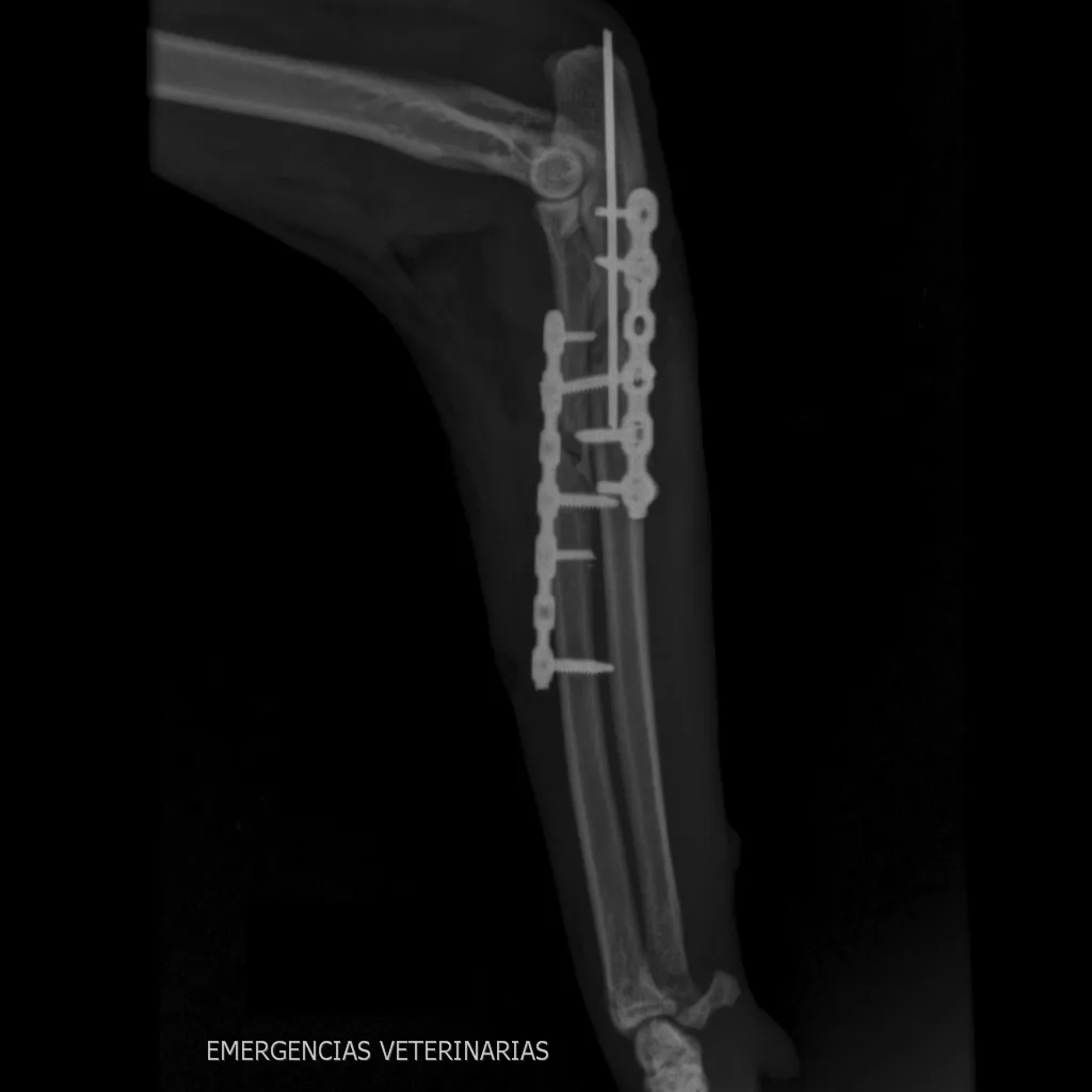 Proximal Radius and Proximal Ulna Fracture with Elbow Dislocation C0015