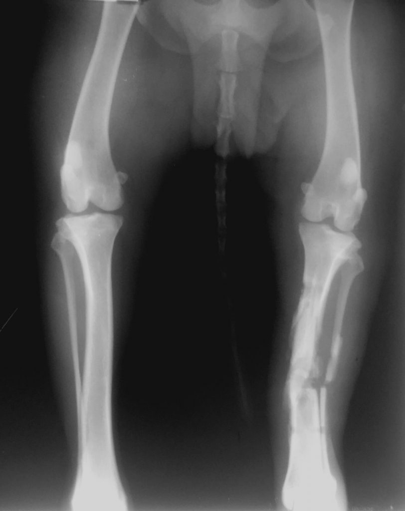 C0005 Fracture Repair Mid-Shaft Tibia