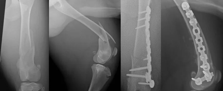 C0007 Fracture Repair Mid-Shaft Femur