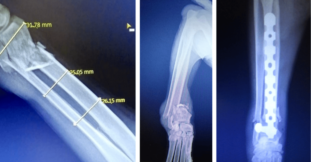 Distal Radius C0041