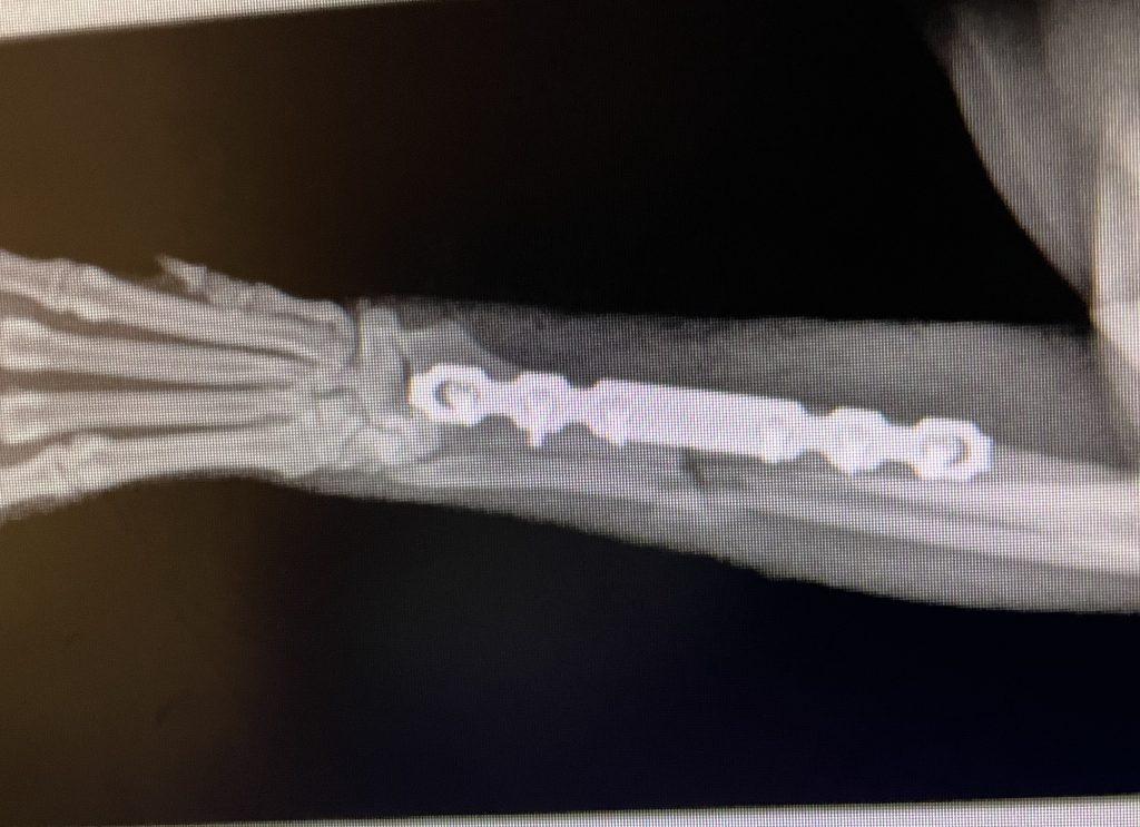 Distal Radius C0049