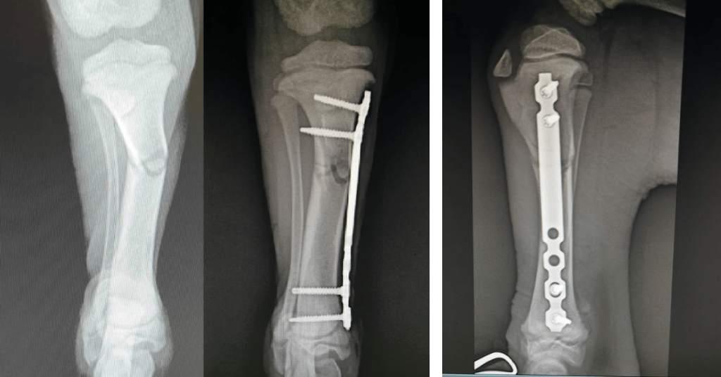 Mid-Shaft Tibia C0052