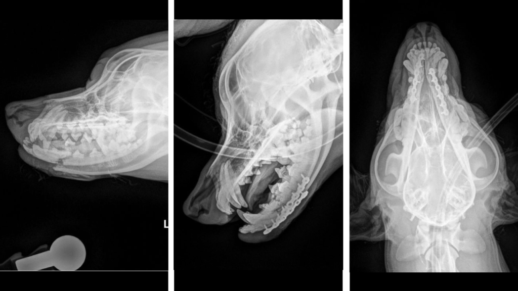 Fracture Repair Bilateral Mandibular C0078