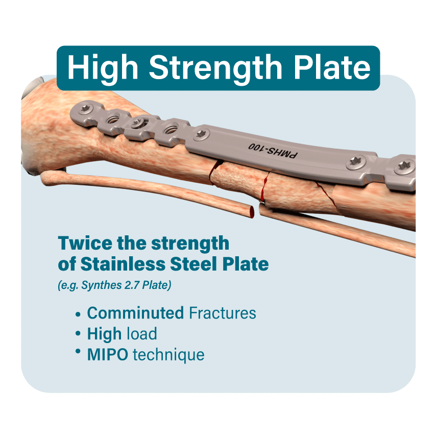Imagen OsteoCertus
High Strength Plate
Twice The strength of stainless steel plate
(e.g. Synthes 2.7 Plate)
Comminuted Fractures
High load
MIPO technique