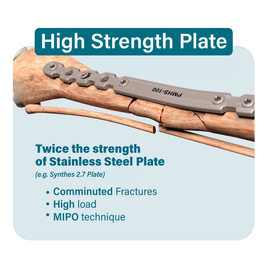 Imagen OsteoCertus
High Strength Plate
Twice The strength of stainless steel plate
(e.g. Synthes 2.7 Plate)
Comminuted Fractures
High load
MIPO technique