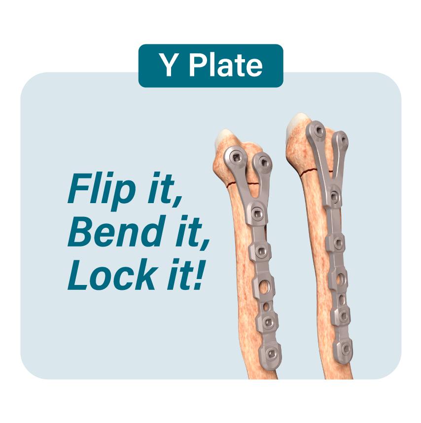 Imagen OsteoCertus
Y Plate
Flip it, bend it, lock it
