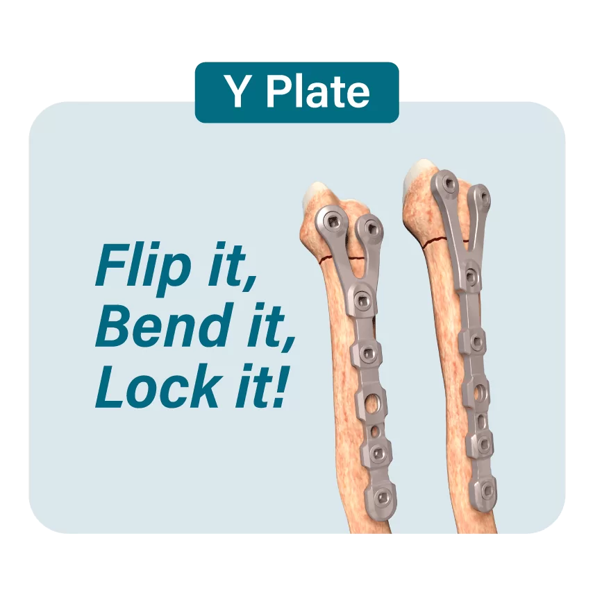 Imagen OsteoCertus
Y Plate
Flip it, bend it, lock it