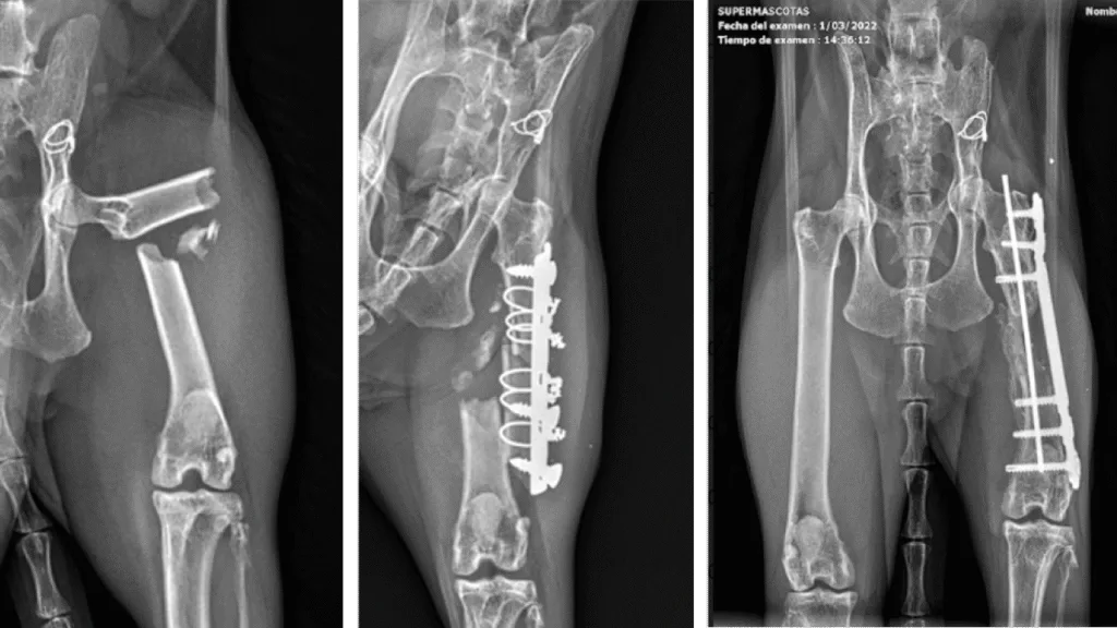 Fracture Repair / Reconstruction Mid-Shaft Femur C0079