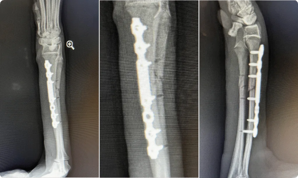 Fracture Repair Mid-Shaft Radius & Ulna C0081