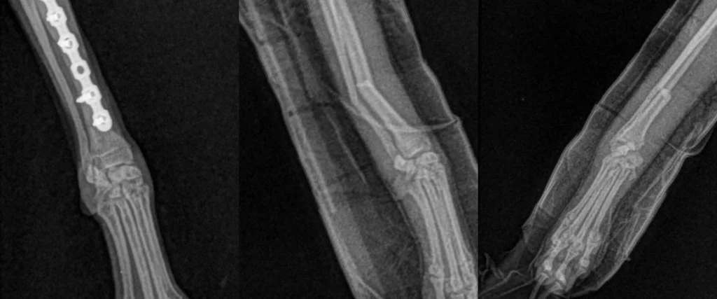 C0093 Fracture Repair Mid-Shaft Tibia