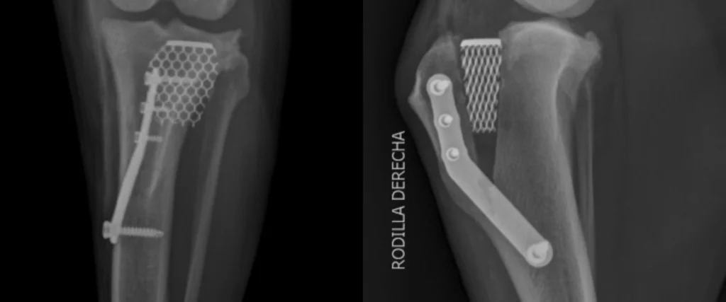 C0092 TTA Proximal Tibia