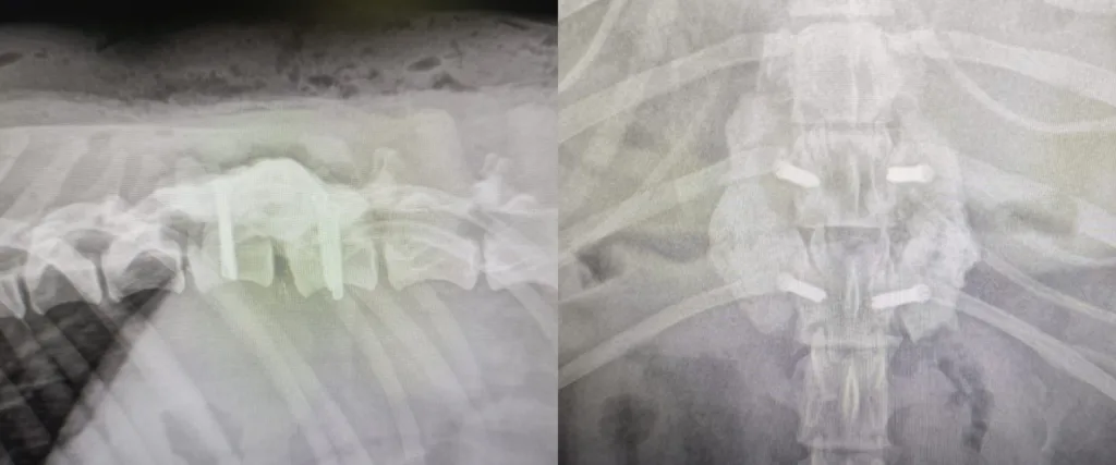 C0098 Fracture Repair / Luxation Repair Spine Toraco-Lumbar  T12-T13