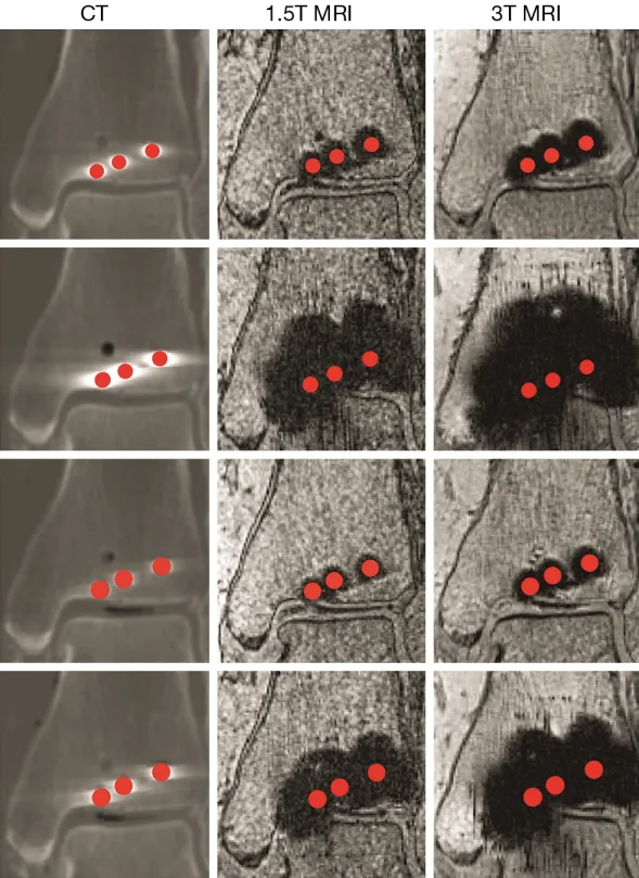 CT, 1.5T MRI and 3T MRI comparison of metal artifacts around orthopedic screws