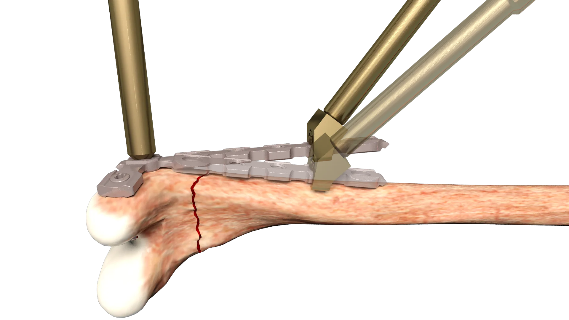 Original cross plate on femur with in-situ bending instruments